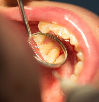 歯周病について